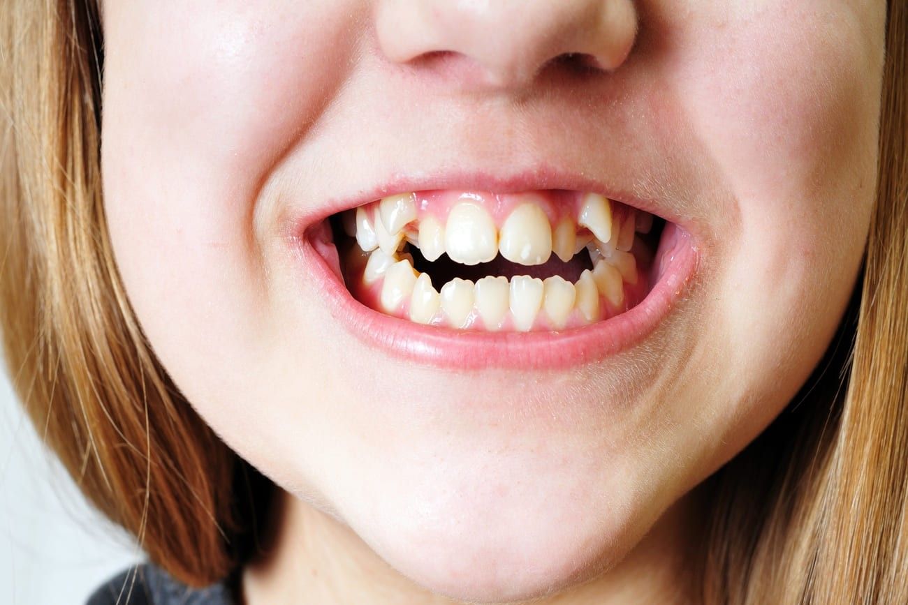 Crooked Teeth – Japan.jpg