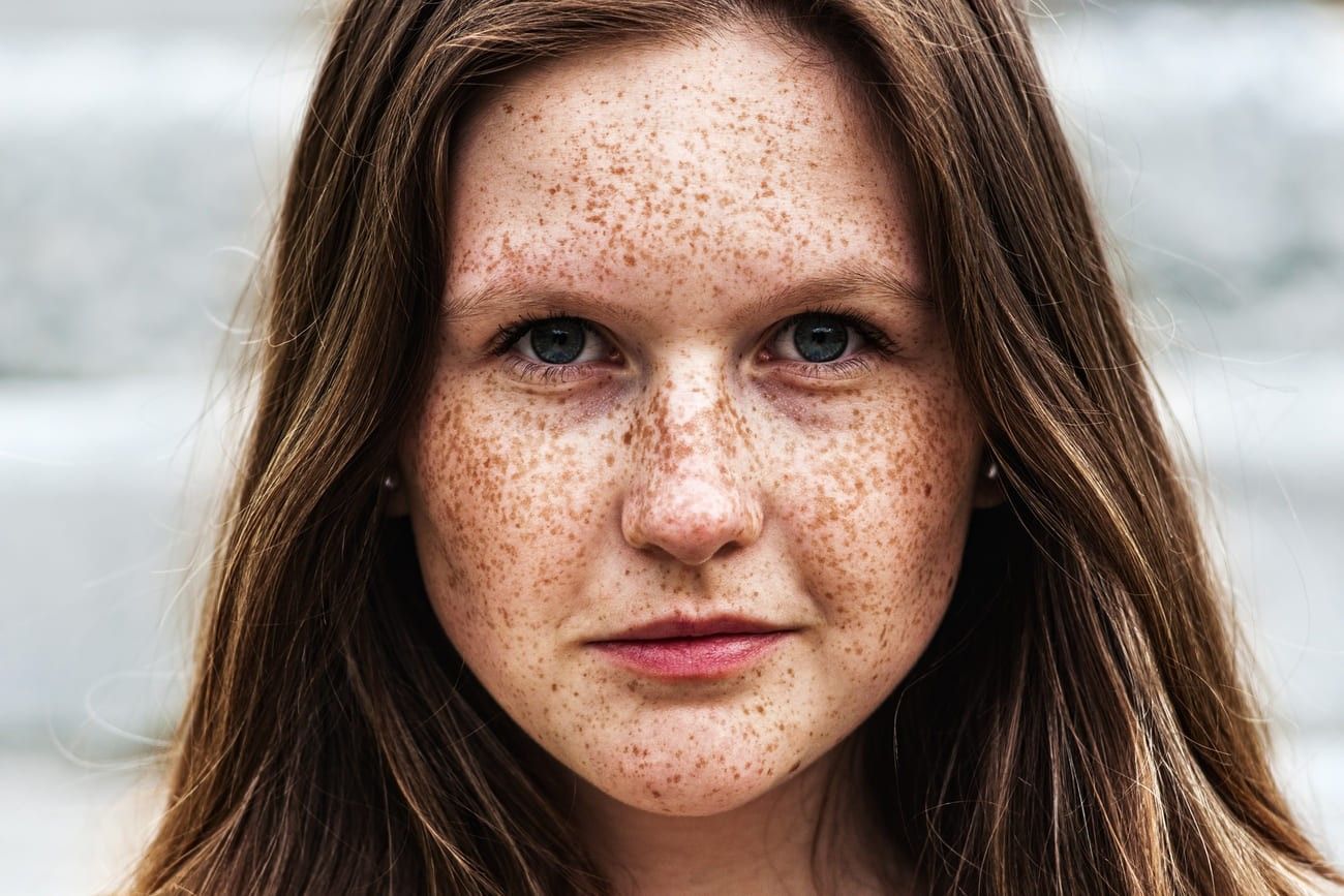 Freckles – Ireland.jpg