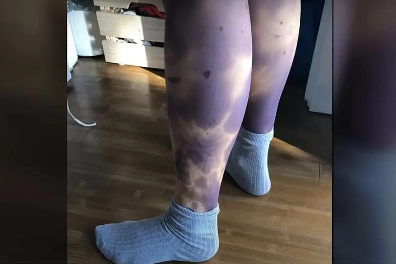 Leggings with the image of bruises.jpg?format=webp